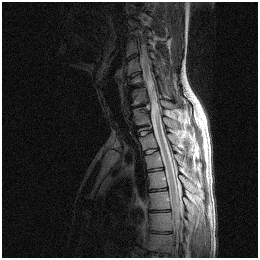 Stem Cell Spine Therapy, Stem Cells, Disability, Disorders, Syndrome