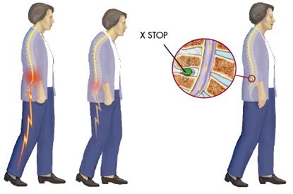 X Stop Spine Surgery Procedure, X Stop, Spine Surgery Procedure, X Stop Procedure, Kyphon