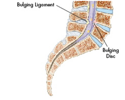 X Stop Spine Surgery Procedure, X Stop, Spine Surgery Procedure