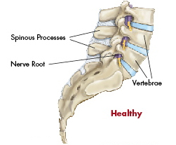 X Stop, Spine Surgery Procedure