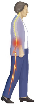 X Stop Spine Surgery Procedure, X Stop Procedure, Kyphon, Spinal Stenosis, Surgery