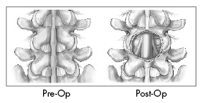 X Stop Spine Surgery Procedure, Spine Surgery Procedure, Kyphon, Surgery