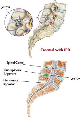 X Stop Spine Surgery Procedure, X Stop, Spinal Stenosis, Surgery, India Hospital Tour