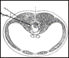 low cost surgery Bangalore, hip replacement,  knee replacement