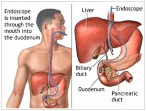 Minimal Access Invasive Surgery Wockhardt Hospital in Mumbai, Invasive Surgery