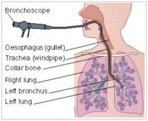 Minimal Access Invasive Surgery Wockhardt Hospital in Mumbai, keyhole-minimal-access-surgery