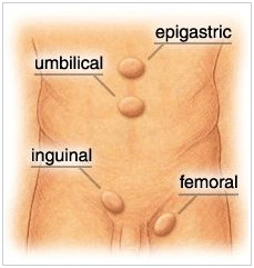 keyhole-minimal-access-surgery, Laparoscopic-Appendectomy