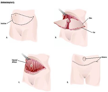 Abdominoplasty Surgery India, Abdominoplasty Info India, Surgery India, Abdominoplasty Surgery Preparation