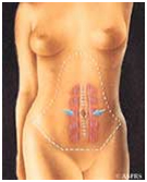 Abdominoplasty Surgery India, Surgery India, Abdominoplasty Surgery Preparation