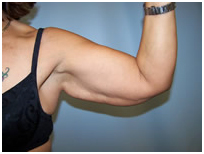 Brachioplasty India, Arm Lift Surgery India, Arm Lift Photos, Surgery In India