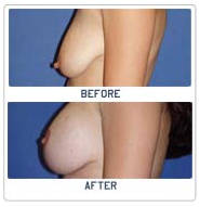 Breast Lift Surgery India, Breast Lift India, Breast, Breast Lift Surgery Pictures