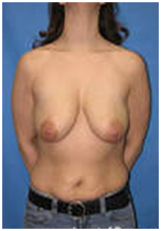 Breast Lift India, Breast, Breast Lift Surgery Pictures, Breast Lift Surgery Photos