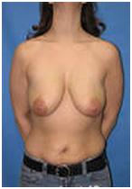Breast Lift India, Breast, Breast Lift Surgery Pictures, Breast Lift Surgery Photos