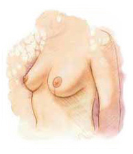 Breast Lift Surgery India, Breast Lift Surgery India, Breast Lift India, Breast