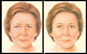 Brow Lift India, Brow Lift Surgery India, Cost Brow Lift Surgery