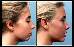 Chin Augmentation Surgery India, Cheek Augmentation Surgery India, Chin Implants