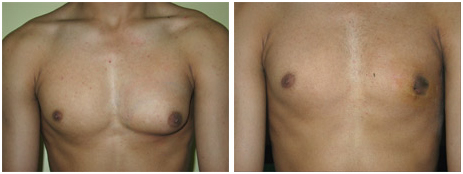 Gynaecomastia Surgery India, Gyno Surgery India, Breast Tissue, Gynaecomastia Surgery India