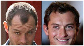 Hair treatment India, Hair Loss Treatment, Hair Loss Problems, Hair Transplant Surgery India