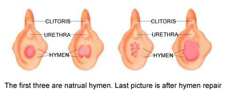 Hymenoplasty Surgery India, Hymen Repair, Hymen Restoration, Hymenoplasty, Hymen Reconstruction