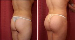 Butt Augmentation Surgery, Butt Augmentation India, Butt Augmentation Surgery India