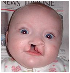 Cleft Lip Surgery, Cleft Lip, Upper Lip, Cleft Palate