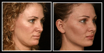 Face Sculpting, Face Sculpting India, Sculpt A Face, Face