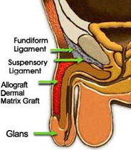 Penis Enlargement Surgery, Penis Enlargement, Penis, Larger Penis, Penis Problems