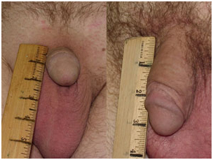 Penis Lengthening Enlargement Surgery, Penis Enlargement, Larger Penis, Penis Enlargement Surgery India