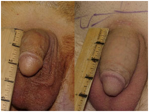 Penis Enlargement Surgery, Penis Enlargement, Penis, Larger Penis, Penis Problems
