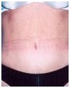 Tummy Tuck Surgery India, Tummy Tuck Surgeon India, Mini Tummy Tuck, Tummy Tuck Surgery Hospitals