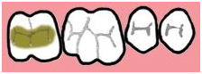 Dental Inlay Treatment India, Porcelain Inlay, Cost Ceramic Dental Inlay