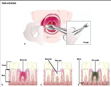 Cost Dental Extraction, Dental India, Low Cost Dental Extraction Mumbai India, Dental Extraction Hospital Mumbai