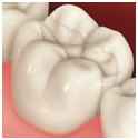 Mercury Fillings, Dental Cavity Fillings Delhi India, Amalgams Fillings, Enamel Fillings