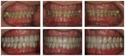Dental Implants India, Full Mouth Dental, Dental Implants India, Full Mouth Restoration Delhi  India