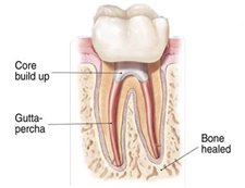 Cost Root Canal Treatment Hospital India, Root Canal Treatment Delhi India