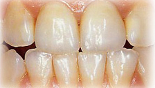 Teeth Empress India, Empress Treatment India, Cost Empress Treatment, Empress Treatment Hospital India