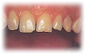 Teeth Empress India, Cost Empress Treatment, Cost Empress Treatment, Empress India