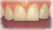 Teeth Empress India, IPS Empress Treatment India, Empress Treatment India, Empress Treatment Hospital India