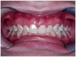 Low Cost Teeth Polishing Fluoride India, teeth whitening cost dentist