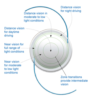 What is an intraocular lens (IOL)?