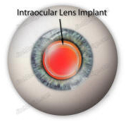 Intraocular Lenses, IOL, Intraocular Lens Implantation