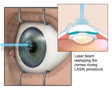 Lasik Surgery India, Lasik Surgery in India, India Lasik Doctors, India Cost Lasik