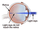 Refractive Errors Surgery, Refractive Error India, Refractive Errors India