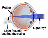 Refractive Error India, Refractive Errors India, Refractive Errors Surgery India