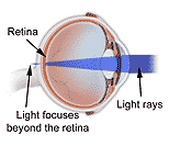 Refractive Errors India, Refractive Errors Surgery India, Corrective Eye Surgery