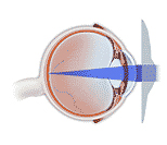 Refractive Errors Surgery, Refractive Error India, Refractive Errors India, Photorefractive Keratectomy Surgery