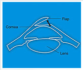 Refractive Errors India, Refractive Errors Surgery India, Corrective Eye Surgery
