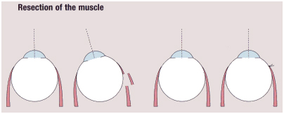 Glaucoma