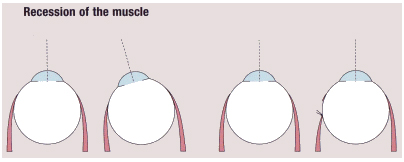 Glaucoma