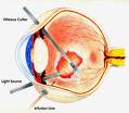 Vitrectomy Surgery, Vitrectomy Surgery India, India Vitrectomy Doctors, India Cost Vitrectomy